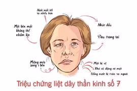 Bác sĩ khuyến cáo, không chủ quan với liệt dây thần kinh số 7