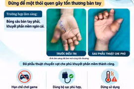 Bệnh nhân bỏng sâu bàn tay do điện thoại nổ khi sạc