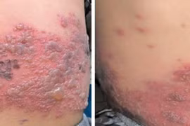 Bé trai 4 tuổi mắc cùng lúc Zona và Thủy đậu, trường hợp hiếm gặp trong y văn
