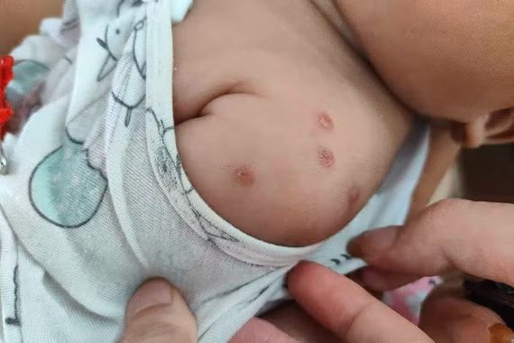 Ký sinh trùng gây thiếu máu, suy dinh dưỡng ở trẻ