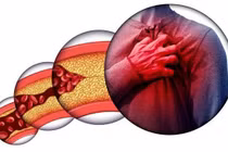 Soi gương thấy 3 dấu hiệu này có thể bạn đã bị mỡ máu cao