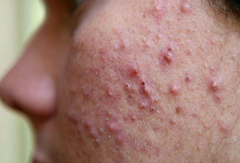 Tẩy tế bào chết cho da mụn - những điều cần tránh