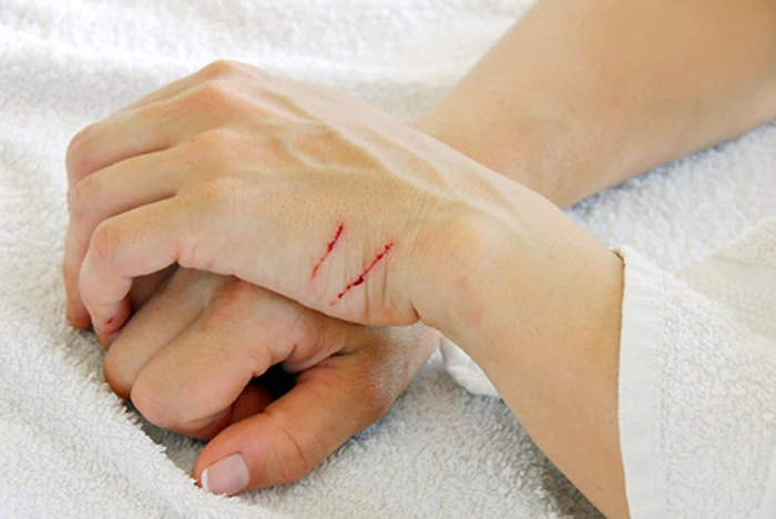 Cách sơ cứu nhanh 8 tai nạn thương tích thường gặp