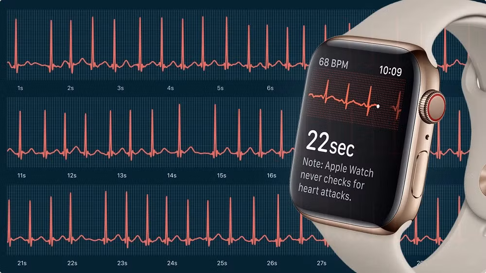 Tuy nhiên, nghiên cứu cũng chỉ ra gần 50% cảnh báo rung nhĩ từ Apple Watch là dương tính giả, dễ gây lo lắng không cần thiết.