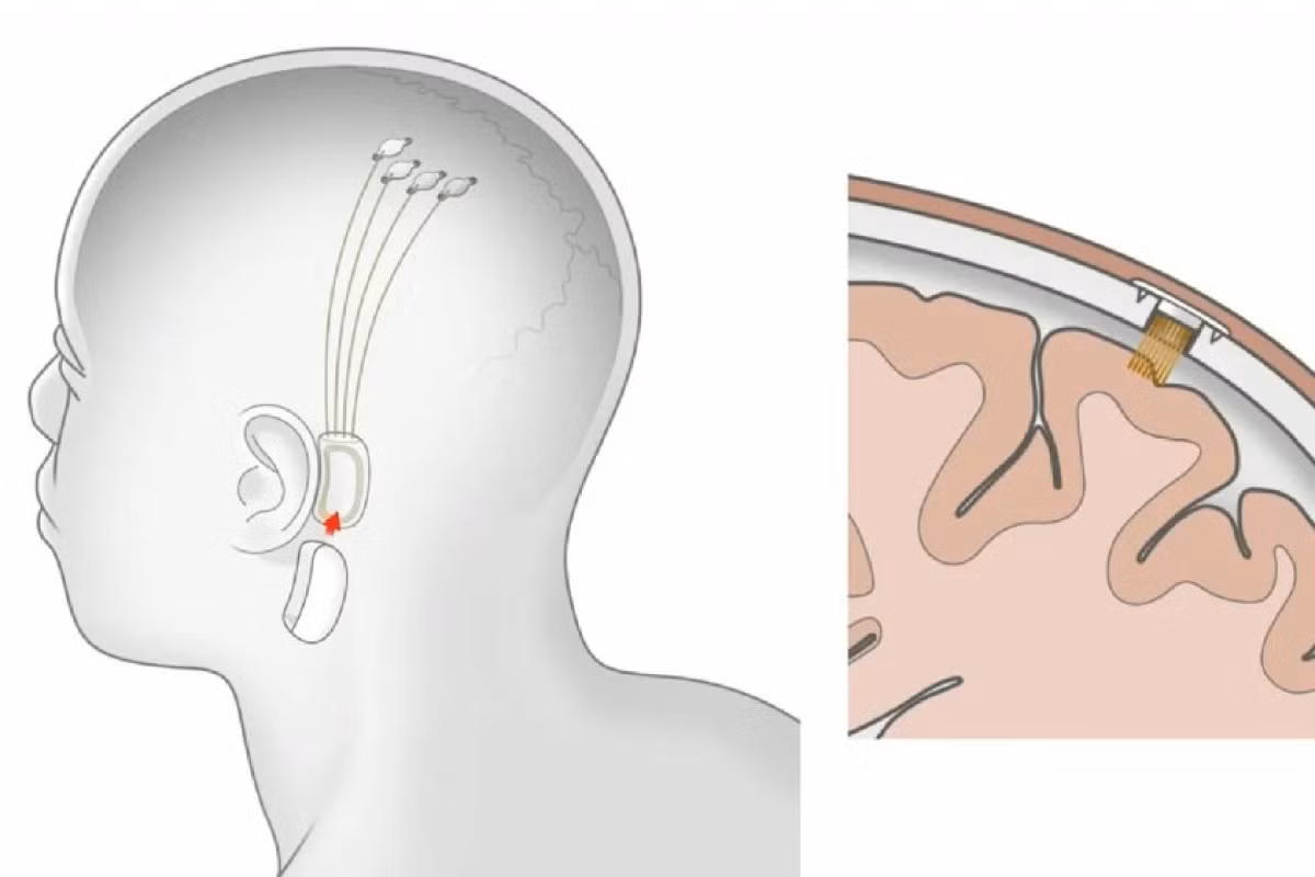 Các chuyên gia cảnh báo rủi ro lâu dài, vấn đề đạo đức và bảo mật dữ liệu thần kinh.