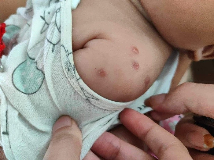 Ký sinh trùng gây thiếu máu, suy dinh dưỡng ở trẻ