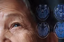 Hy vọng mới trong điều trị Parkinson với liệu pháp tế bào gốc chỉnh sửa gene