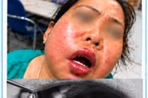 Điều trị tủy răng, người bệnh đái tháo đường nhiễm trùng không há được miệng