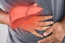Sau nút mạch hóa chất u gan, chăm sóc đúng giảm biến chứng