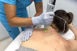 Trị mụn lưng tại spa, nữ bệnh nhân bị ngộ độc thuốc gây tê