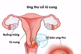 Ung thư cổ tử cung nguy cơ tử vong, phòng bệnh trước khi quá muộn
