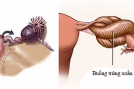 Bé 18 tháng tuổi bị cắt bỏ 1 buồng trứng