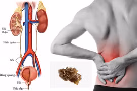 Bí quyết khỏe đẹp: 5 động tác đẩy sỏi tiết niệu ra ngoài