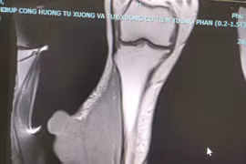 2 lần phẫu thuật u nhỏ như vảy ốc mới phát hiện ung thư di căn
