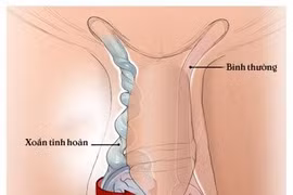 Bé 11 tuổi phải cắt bỏ tinh hoàn do xoắn