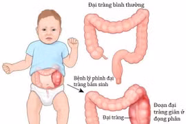 Nhiều trẻ táo bón kéo dài do phình đại tràng cần phải phẫu thuật