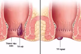 Thanh niên 27 tuổi hoại tử tầng sinh môn do tự đắp thuốc chữa trĩ