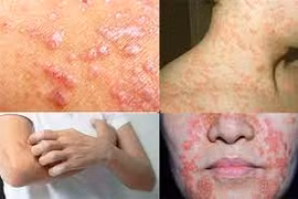 Cách phòng bệnh da liễu khi thời tiết thay đổi