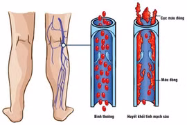 Dùng thuốc tránh thai kéo dài, phụ nữ 35 tuổi bị huyết khối tĩnh mạch sâu