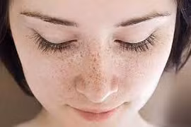 Chuyên gia mách cách chữa trị và phòng ngừa tàn nhang