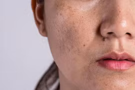 Bác sĩ da liễu mách cách phòng ngừa bệnh da mùa hè