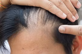 Rụng tóc từng mảng