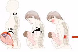 Cách tránh loãng xương sau sinh