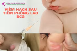 Bác sĩ chỉ cách xử trí viêm hạch sau tiêm phòng vắc xin lao