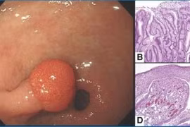 Polyp u tuyến dạ dày có ung thư?