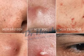 Chuyên gia mách các nguyên tắc trị mụn trứng cá hiệu quả