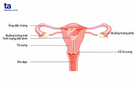 Chưa có chồng bị dính buồng tử cung?