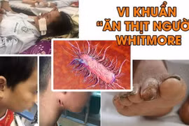 Cứu sống trẻ bị nhiễm vi khuẩn ăn thịt người