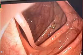 Nội soi phát hiện giun đũa 10 cm đang vận động trong đại tràng