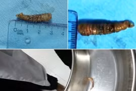 Kinh hoàng con sâu dài 3cm ký sinh trong mắt bệnh nhân