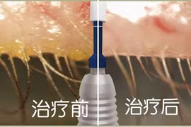 Đau mắt, cô gái hoảng hồn phát hiện nhung nhúc “vật thể lạ”
