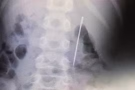 Giấu mẹ một việc, bé 8 tuổi suýt thủng ruột, phải phẫu thuật gấp