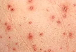 Tự mua thuốc Corticoid chữa thủy đậu, thanh niên 28 tuổi ở Sơn La tử vong