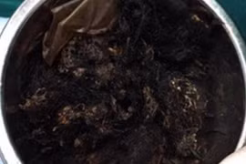 Kỳ lạ cô bé ăn tóc trong suốt 6 tháng ròng
