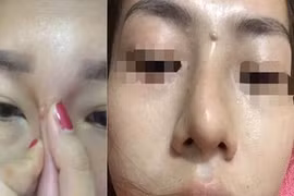 Nhận trái đắng từ trào lưu nâng mũi bằng tiêm filler