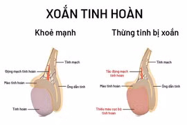 Đang ngủ tỉnh giấc vì đau, thanh niên 16 tuổi bị xoắn tinh hoàn hoại tử