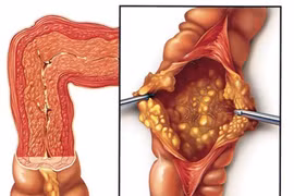 Tự ý dùng kháng sinh cụ bà 81 tuổi bị suy thận, viêm đại tràng nặng