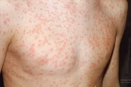 Nhiễm sởi, rubella... cẩn thận di chứng nặng suốt đời