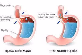 Vì sao điều trị trào ngược dạ dày thực quản nhiều cách nhưng lâu khỏi?