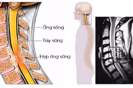 Tắm muộn, nữ sinh 20 tuổi đột ngột bị yếu liệt tay chân do viêm tủy