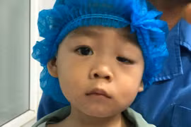 Phẫu thuật sụp mí sớm tránh nhược thị và nhiều biến chứng nguy hiểm