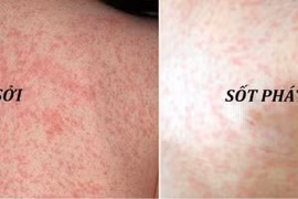 Sởi tăng 8 lần, ho gà tăng 25 lần: Bộ Y tế chỉ đạo phòng dịch