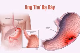 Bác sĩ mách dấu hiệu ung thư dạ dày giai đoạn muộn không nên bỏ qua