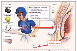 Ngừng tim đột ngột liên quan đến hoạt động thể thao, do đâu?
