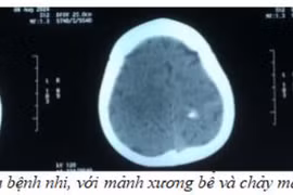 Bị thanh ray cửa sắt rơi trúng đầu, bé 29 tháng tuổi nhập viện cấp cứu