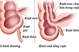 Bác sĩ chỉ cách chăm sóc trẻ tháo lồng ruột bằng hơi tại nhà